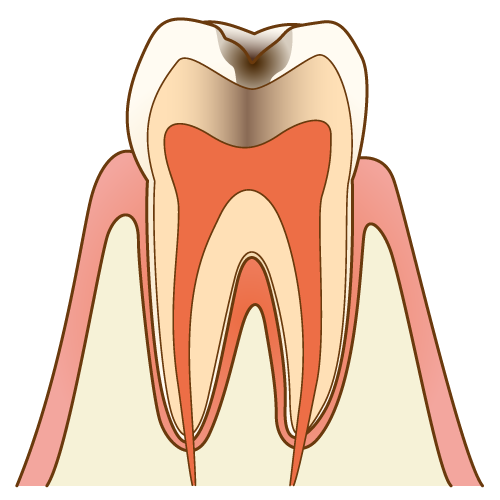 象牙質にまで虫歯が進行している歯