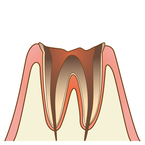 虫歯の進行で歯の根っこしか残っていない歯