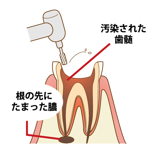 根管治療を始める為虫歯を削っている状態