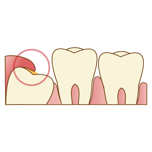 生えかけの親知らずに歯垢が溜まり歯茎が腫れている